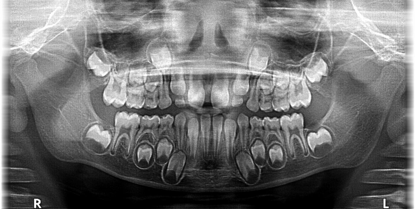 Teeth Tomorrow Radiograph digital radiographs – Happy Teeth
